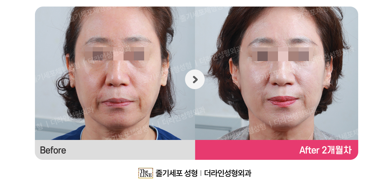 전사진