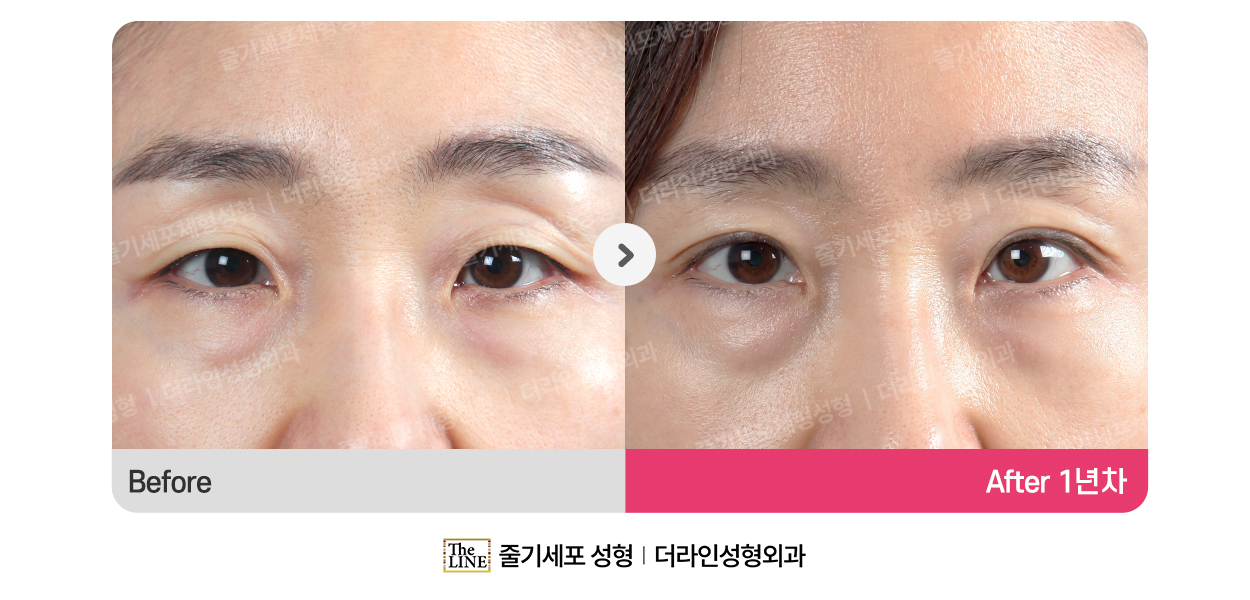 전사진
