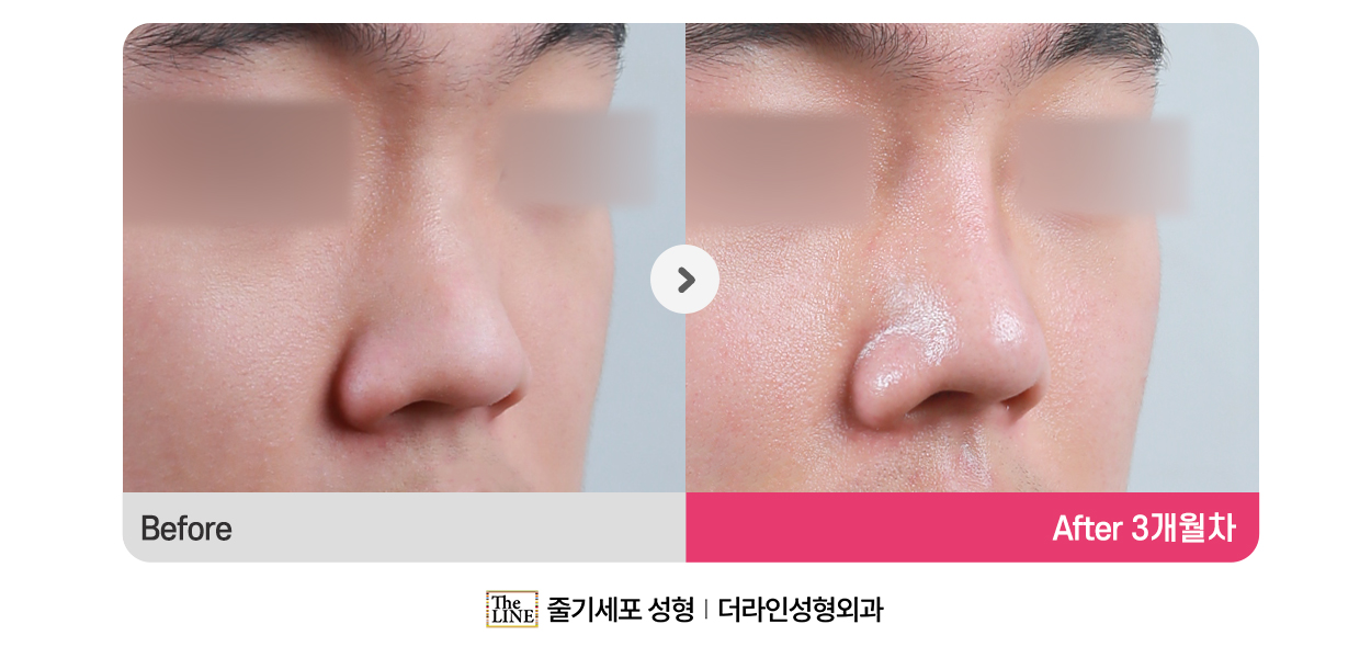 전사진
