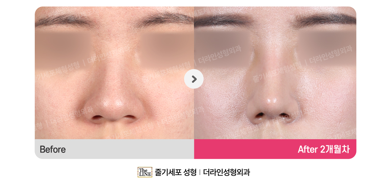전사진