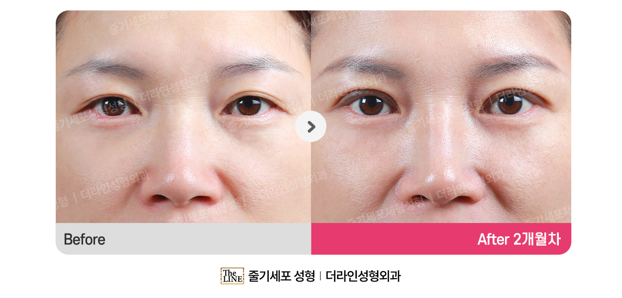 전사진