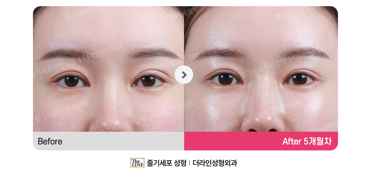 전사진