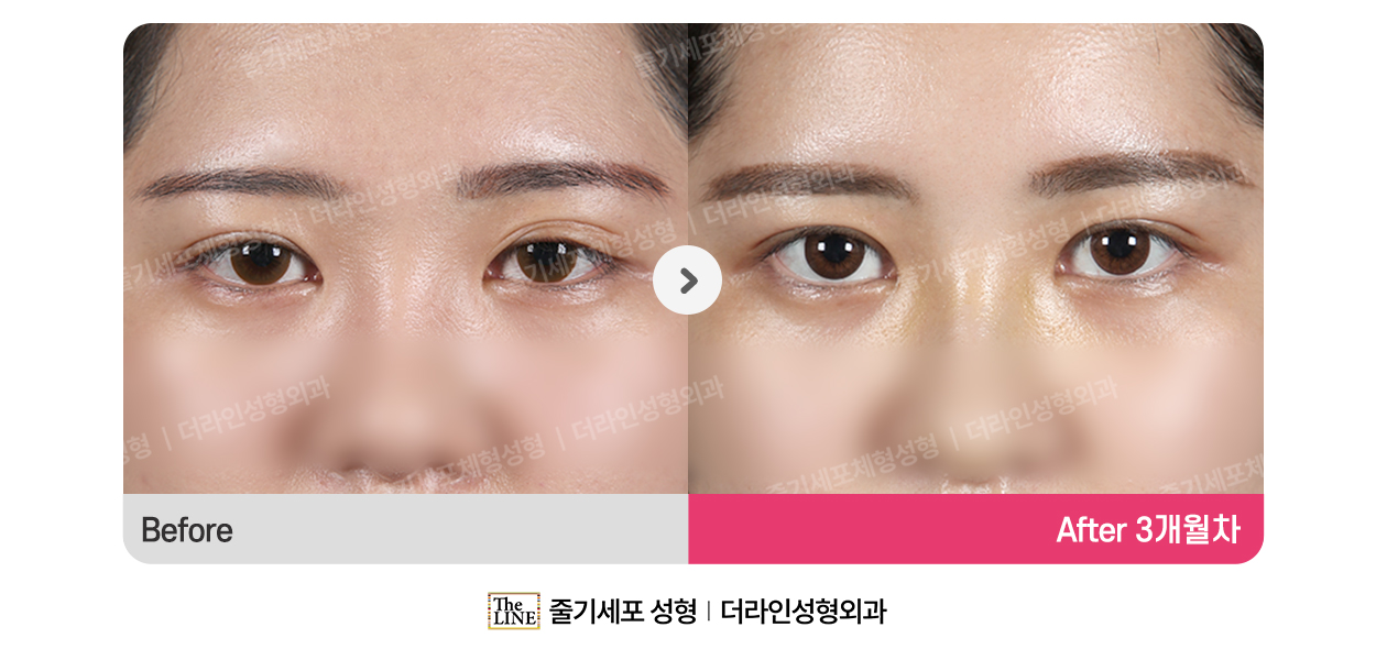 전사진