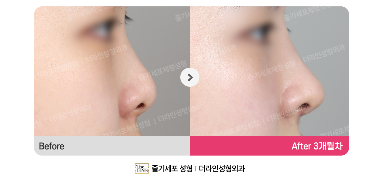 전사진