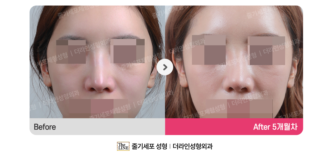 전사진