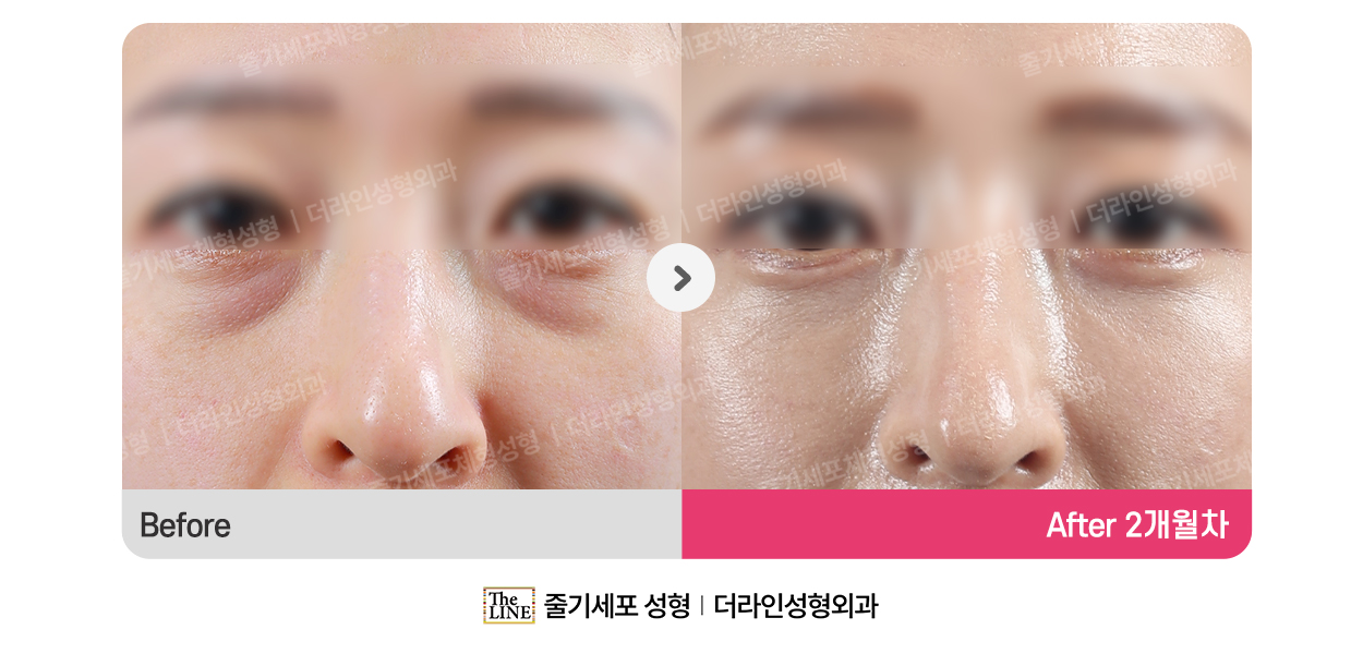 전사진