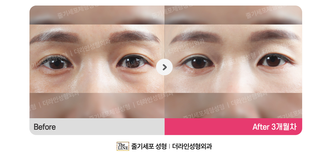 전사진