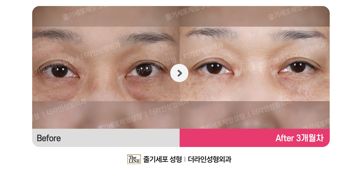 전사진